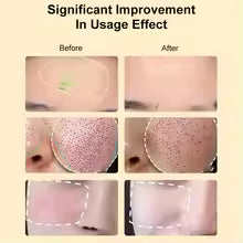 Finesse Facial LED light therapy face mask